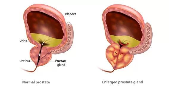 enlarged prostate gland in dogs