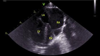 aneurisma felino apêndice atrial direito