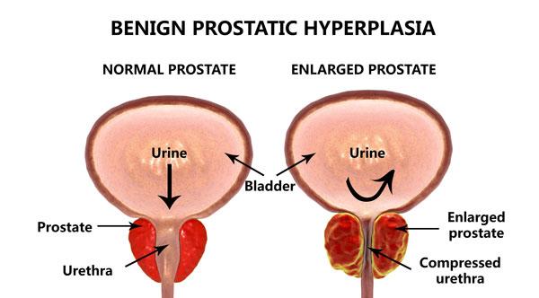 benign prostatic hyperplasia in dogs