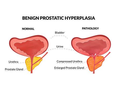 benign prostatic hyperplasia in dogs