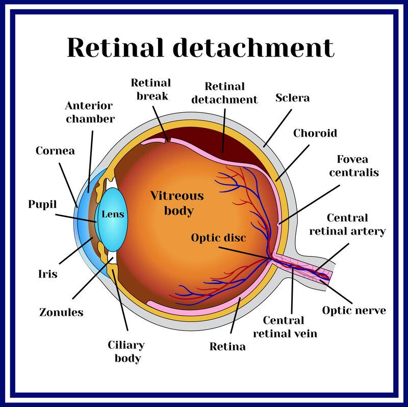 Retinal Detachment in Dogs