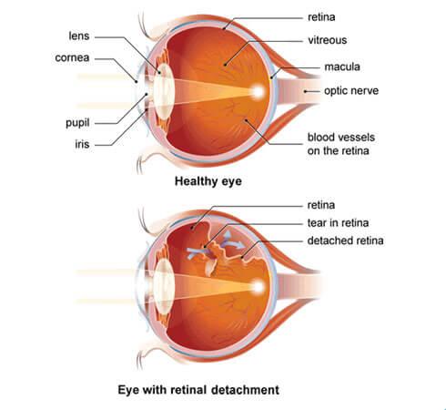 Retinal Detachment in Dogs