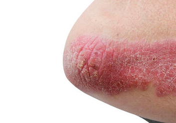 Psoriasis in humans