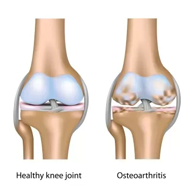 Arthritis and Osteoarthritis