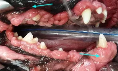 Symptoms of Gingival Hyperplasia