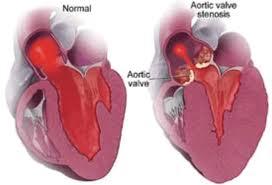 aortic/subaortic stenosis in dogs