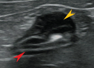 Feline Alimentary Lymphoma