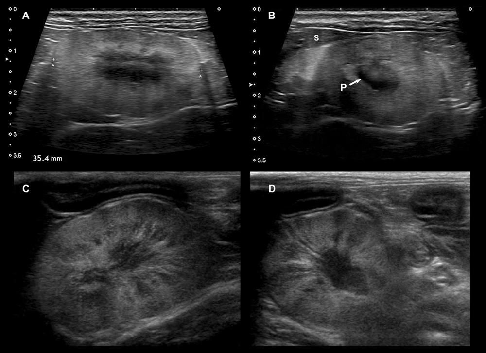 Feline Kidney Lymphoma