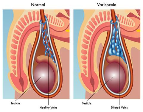 ¿Pueden los perros contraer un varicocele en el escroto?