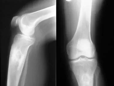 osteomyelitis in dogs